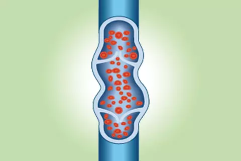 Illustration einer Vene mit Thrombose