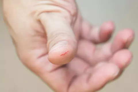 Männerhand mit verletztem Daumen