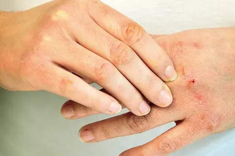 Detailaufnahme einer Person mit wunden Knöcheln