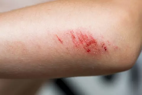 Detailaufnahme einer Schürfwunde am Arm
