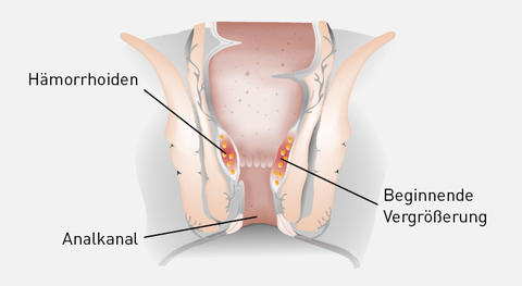 Illustration Hämorrhoiden 1. Grades