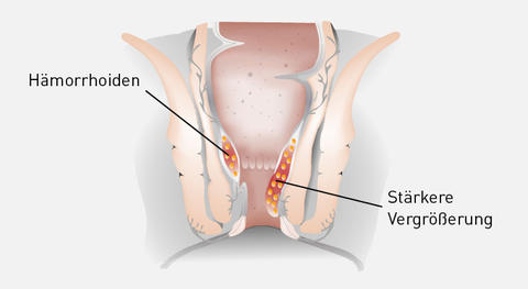 Illustration Hämorrhoiden 2. Grades
