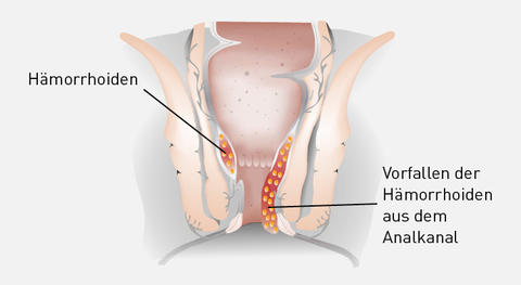 Illustration Hämorrhoiden 3. Grades