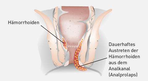 Illustration Hämorrhoiden 3. Grades
