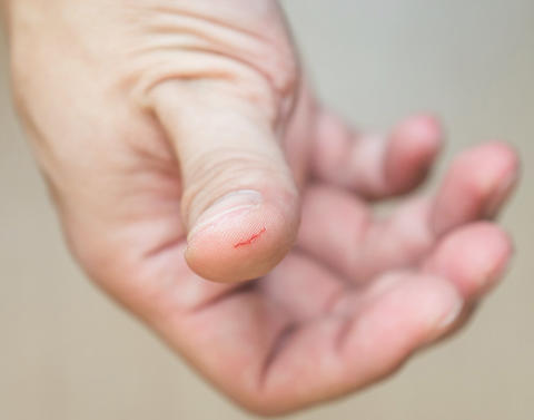 Männerhand mit verletztem Daumen