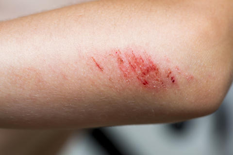 Detailaufnahme einer Schürfwunde am Arm